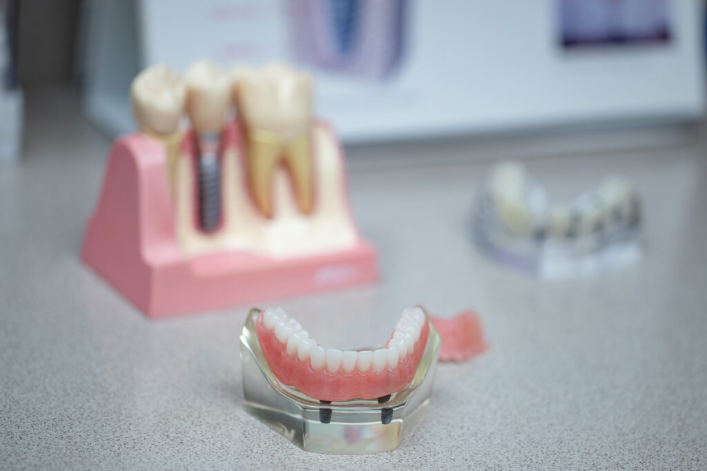 models of dental implants