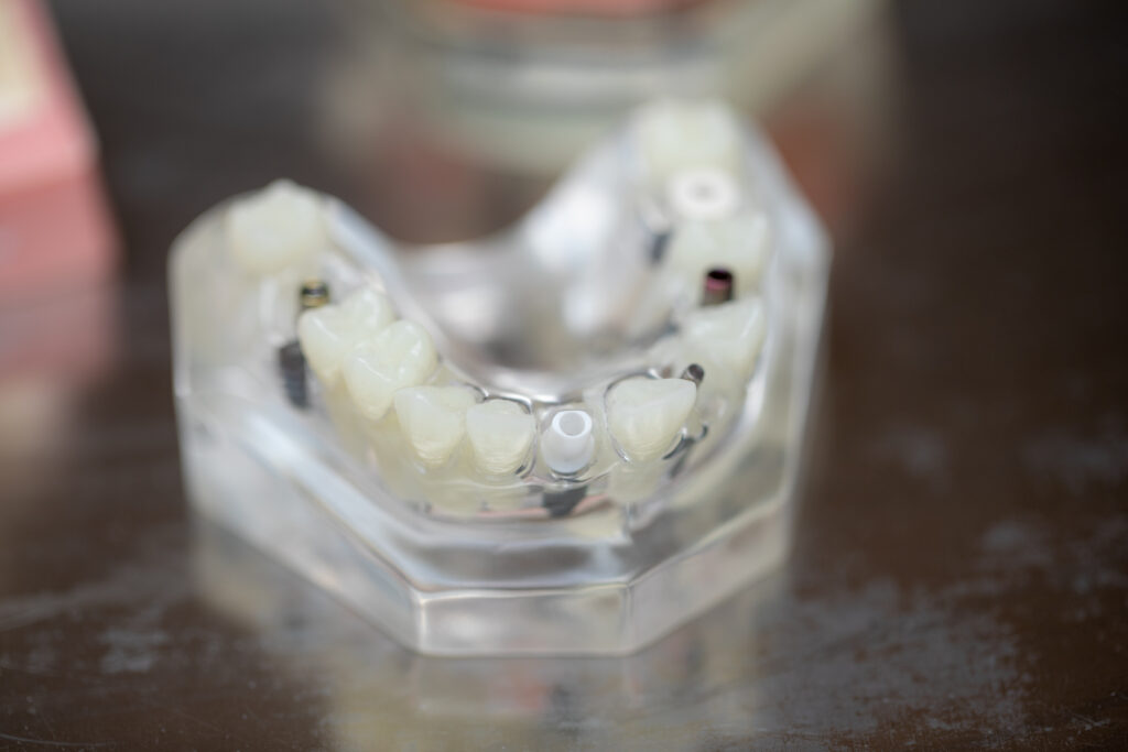 dental implant model