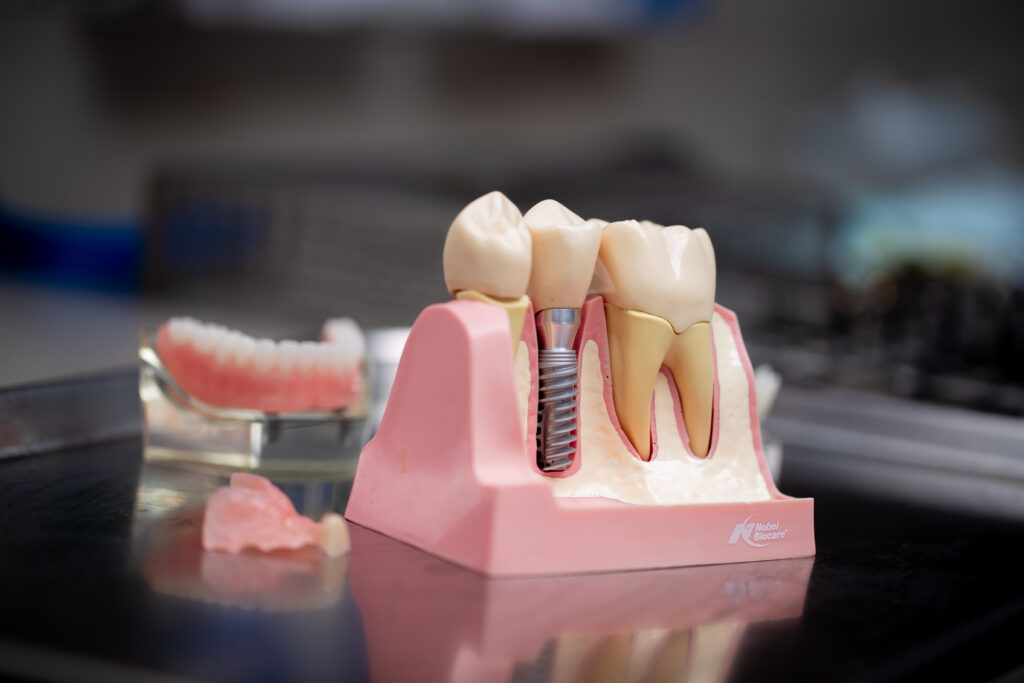 dental implant model