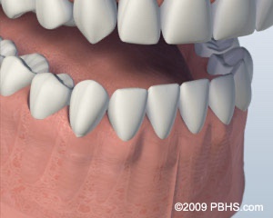 graphic with individual implants healed completely