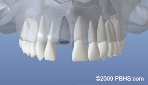 graphic showing tooth loss