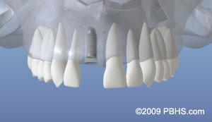 graphic showing an implant placed