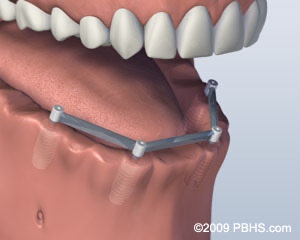 graphic with bar implants placed