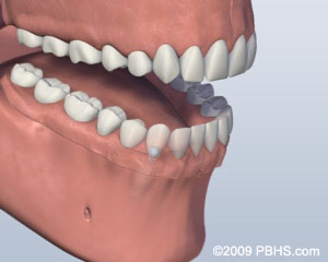 graphic showing jaw with lower implants placed