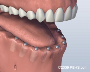 graphic with screw implants placed