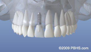 graphic showing a normal dental implant