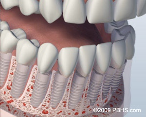 graphic with individual implants placed