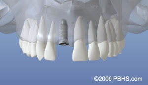 graphic showing implant placed and healed