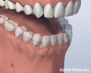 graphic with dentures attached to a bar attachment