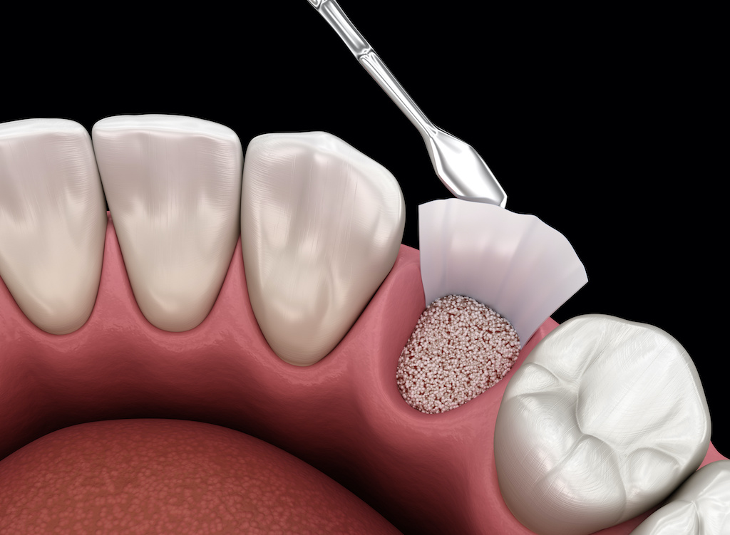 graphic of bone grafting