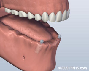 graphic of lower jaw with implants placed