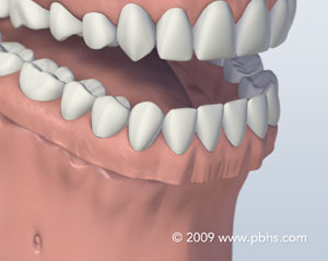 graphic of a mouth with dentures