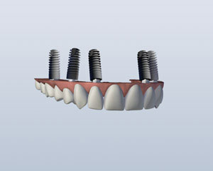 implant retained upper denture