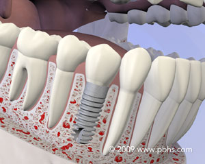 graphic of a mouth with a dental implant