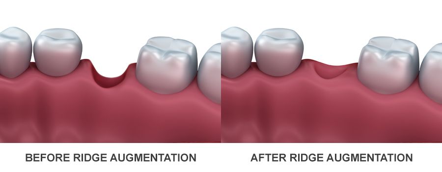 before and after ridge augmentation